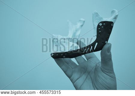 Man Holding Implantation Of Endoprosthesis Of Lower Jaw. Model Of Lower Jaw Printed On 3d Printer Wh