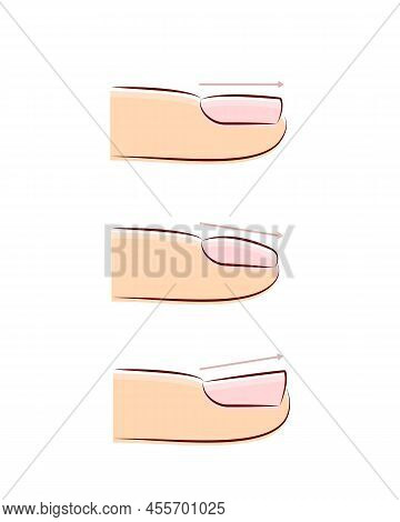 Direction Of Nail Growth, Different Types Of Fingernail, Flat, Convex And Concave Nails, Nail Extens