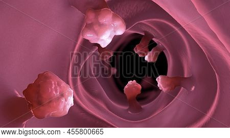 Close-up View Of Intestinal Polyps And Diseased Intestinal Tissue That Can Cause Cancer - 3d Illustr