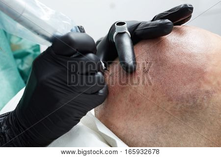 Cosmetologist making permanent makeup on man head - tricopigmentation