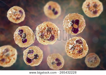 Meningococcal Meningitis, Cerebrospinal Fluid Smear Containing Neutrophils With And Without Bacteria