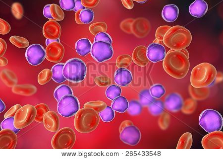 Acute Lymphoblastic Leukemia, Bone Marrow Smear, 3d Illustration