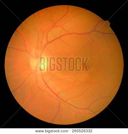 The Image Of The Retina, Retinal Photography Machine To Find Diabetic Eye Upward.