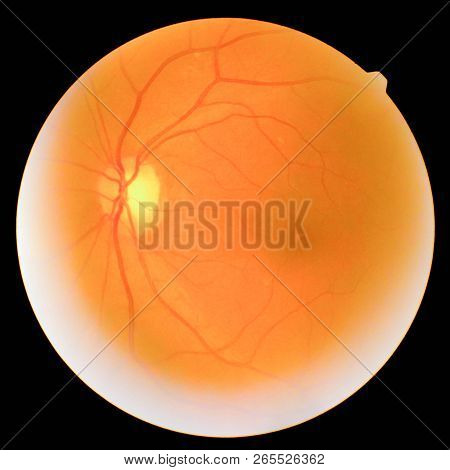 The Image Of The Retina, Retinal Photography Machine To Find Diabetic Eye Upward.