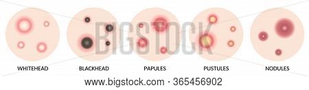Types Of Acne Illustration. White Head,black Head, Papules, And Pustules. Beauty Skin Care Concept