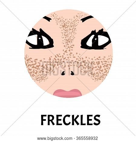 Freckles On The Face. Pigmentation On The Skin. A Pigmented Spot On The Skin Of The Face. Vector Ill