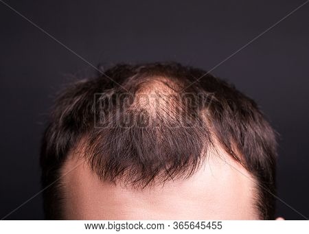 Male Head Close-up With Baldness. Studio Black Background.