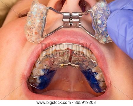 Dentist Work With Braces And Children Mouth With Birth Teeth Deformation. Fix Of Palatal Closing Out