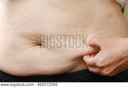 Close Up Of Mother Womans Belly Showing Stretch Mark Loose Lower Abdomen Skin She Fat After Pregnanc