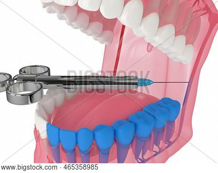 3d Render Of Human Jaw With Inferior Alveolar Nerve Block Technique. Dental Anesthesia Techniques Co