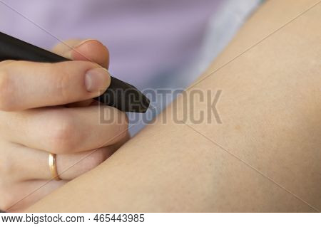 Removing Hair Permanently With A Needle Using An Electroepilator. Removal Of Hair By Electric Shock 