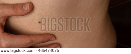 Unrecognizable Woman Showing Her Birthmarks On Skin Close Up Detail Of The Bare Skin Banner Sun Expo
