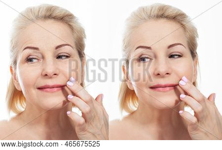 Middle Age Close Up Woman Face Before After Cosmetic Procedures. Skin Care For Wrinkled Face. Before