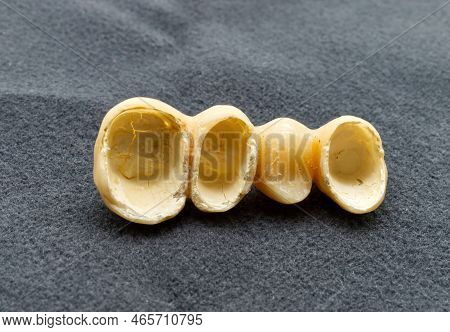Provisional Dental Bridge Isolated On Grey Background. Temporary Resin Teeth. Dental Health And Impl
