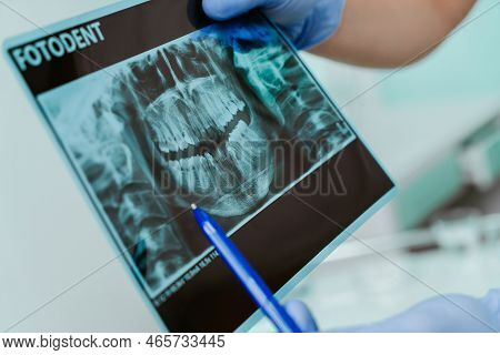 Hands Doctor Dentist In Gloves Show The Teeth On X-ray Foto In Dental Clinic On Light Background Wit