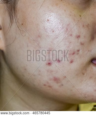 Acne Vulgaris And Scars On The Cheek Of Southeast Asian Woman. Acne Occurs When Hair Follicles Becom