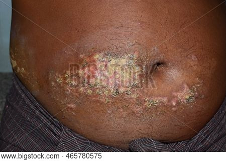 Chronic Dermatitis Or Fungal Infection In Abdomen Of Southeast Asian Man.