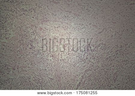 Cells of human skin with squamous cell carcinoma under a microscope.