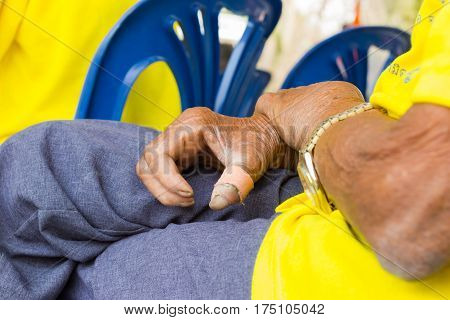 closeup hand of old asian man suffering from leprosy amputated hand