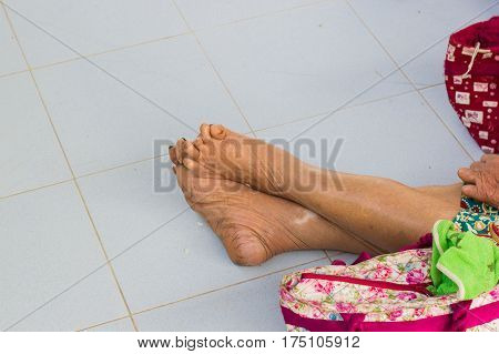 closeup feet of old asian man suffering from leprosy with a cane on the ground
