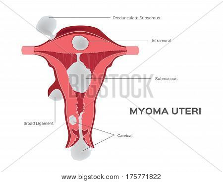 cancer and tumor in women uterus vector