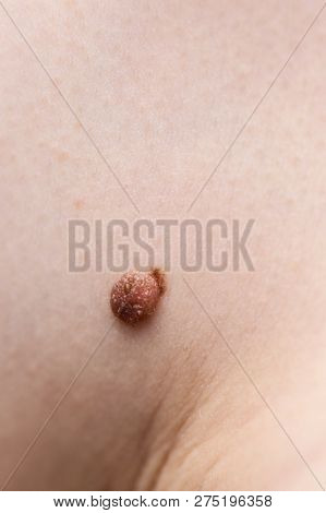 Unrecognizable Person Having Dark Fibroma, Dermatology Problem On Skin. Close Up Of Papilloma Dermat