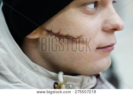 Scarface. A Young Man With A Big Scar On His Face