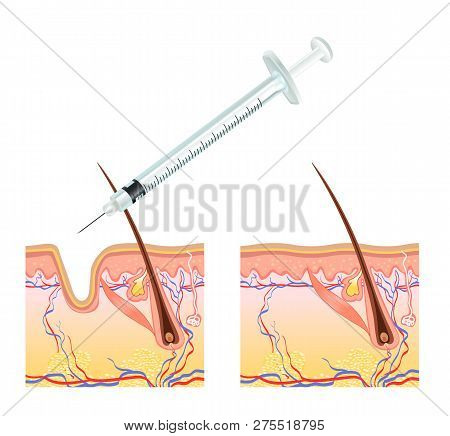 Biorevitalization With Hyaluronic Acid Treatment Of Mimic Wrinkles Under The Eyes Reduces Unwanted S