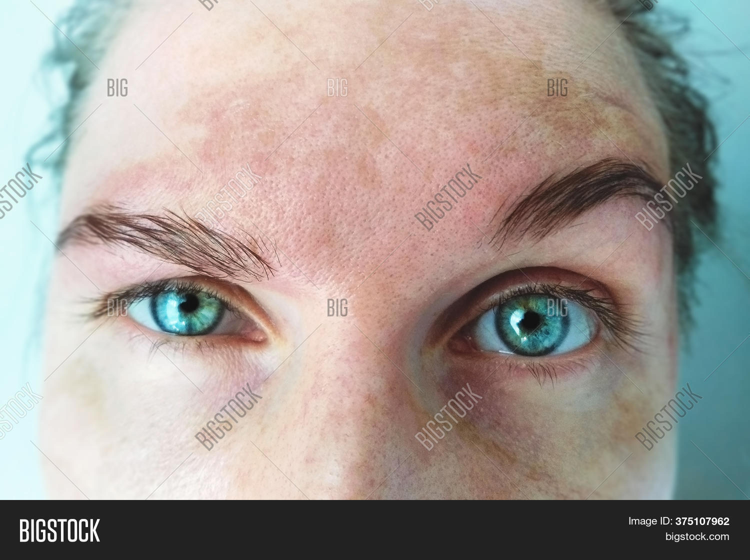 melasma facial
