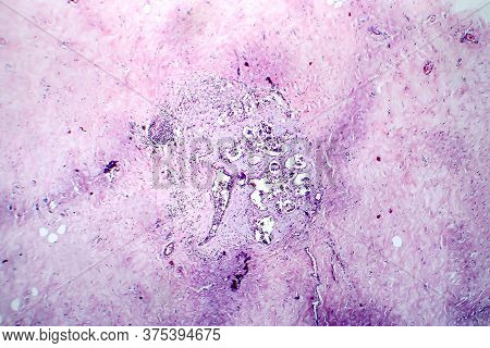 Breast Fibroadenosis, Light Micrograph, Photo Under Microscope. Common Benign Hyperplastic Process I