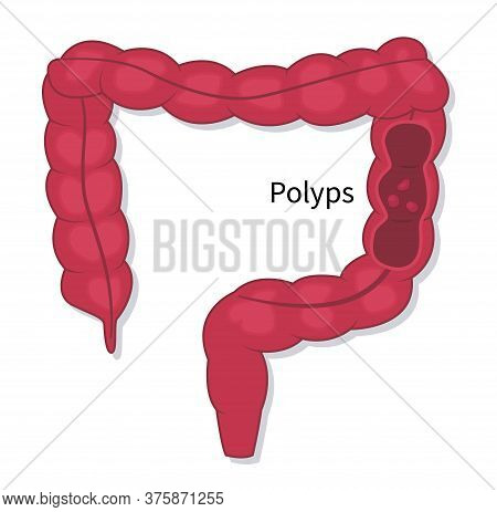 Colonoscopy Endoscopic Examination Of The Large Bowel. Colorectal Cancer Screening. Flat Vector Illu