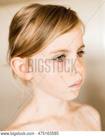Chickenpox, Varicella Virus Or Vesicular Rash On Little Girl Body And Face. Close-up Portrait Of Kid