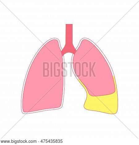 Chylothorax Disease. Lymphatic Fluid Between Layers Of Tissue In Lungs And Chest Wall. Severe Cough,