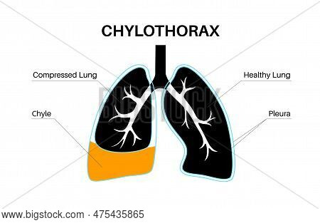 Chylothorax Disease. Lymphatic Fluid Between Layers Of Tissue In Lungs And Chest Wall. Severe Cough,