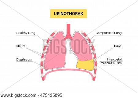 Urinothorax Disease. Urine Collects In Fluid-filled Cavity In Lungs. Chest Pain, Difficulty Breathin