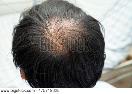 Bald In The Middle Head And Begin No Loss Hair Glabrous Of Mature Asian Business Smart Active Office