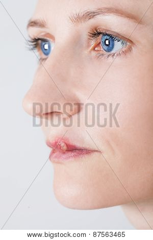 beautiful woman with lips virus infected herpes