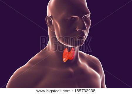 Thyroid cancer. 3D illustration showing thyroid gland with tumor inside human body