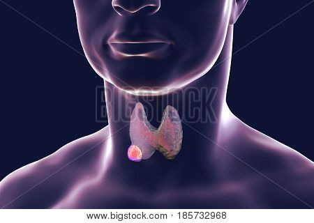 Thyroid cancer. 3D illustration showing thyroid gland with tumor inside human body