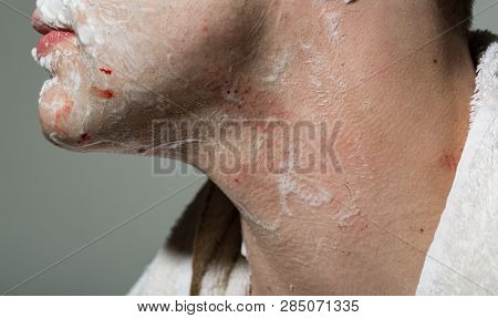 After Shaving. Scratched Neck Of A Man. Mans Neck In Cut. Unfashionable And Painful To Shave A Beard