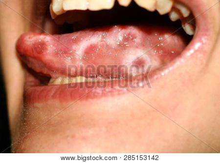 Amphotoid Stomatitis. Candidiasis Of The Tongue. Ulcer On The Tongue. Candida Fungus.