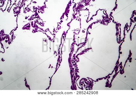 Histopathology Of Lung Emphysema, Light Micrograph, Photo Under Microscope Showing Enlargement Of Ai