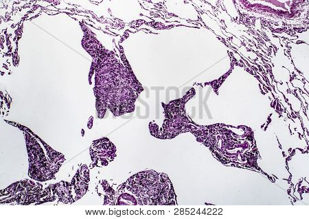 Histopathology Of Lung Emphysema, Light Micrograph, Photo Under Microscope Showing Enlargement Of Ai