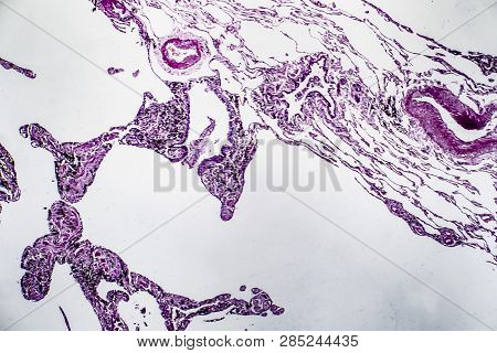 Histopathology Of Lung Emphysema, Light Micrograph, Photo Under Microscope Showing Enlargement Of Ai