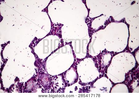 Histopathology Of Pneumonia, Light Micrograph, Photo Under Microscope. Cellulose Aspiration Pneumoni