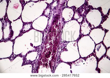 Histopathology Of Pneumonia, Light Micrograph, Photo Under Microscope. Cellulose Aspiration Pneumoni
