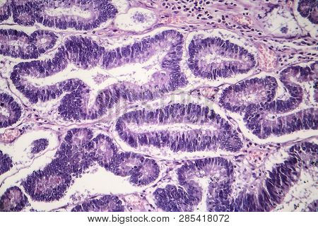 Histopathology Of Intestinal Adenoma, Light Micrograph, Photo Under Microscope