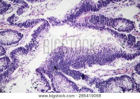 Histopathology Of Intestinal Adenoma, Light Micrograph, Photo Under Microscope