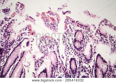 Histopathology Of Chronic Atrophic Gastritis, Light Micrograph, Photo Under Microscope