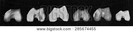 Comparative table of the surface of the knee joint of the femur of a European, an Australian, the Neanderthal man, an Australian, an African and a African dwarf, vintage engraved illustration. From t